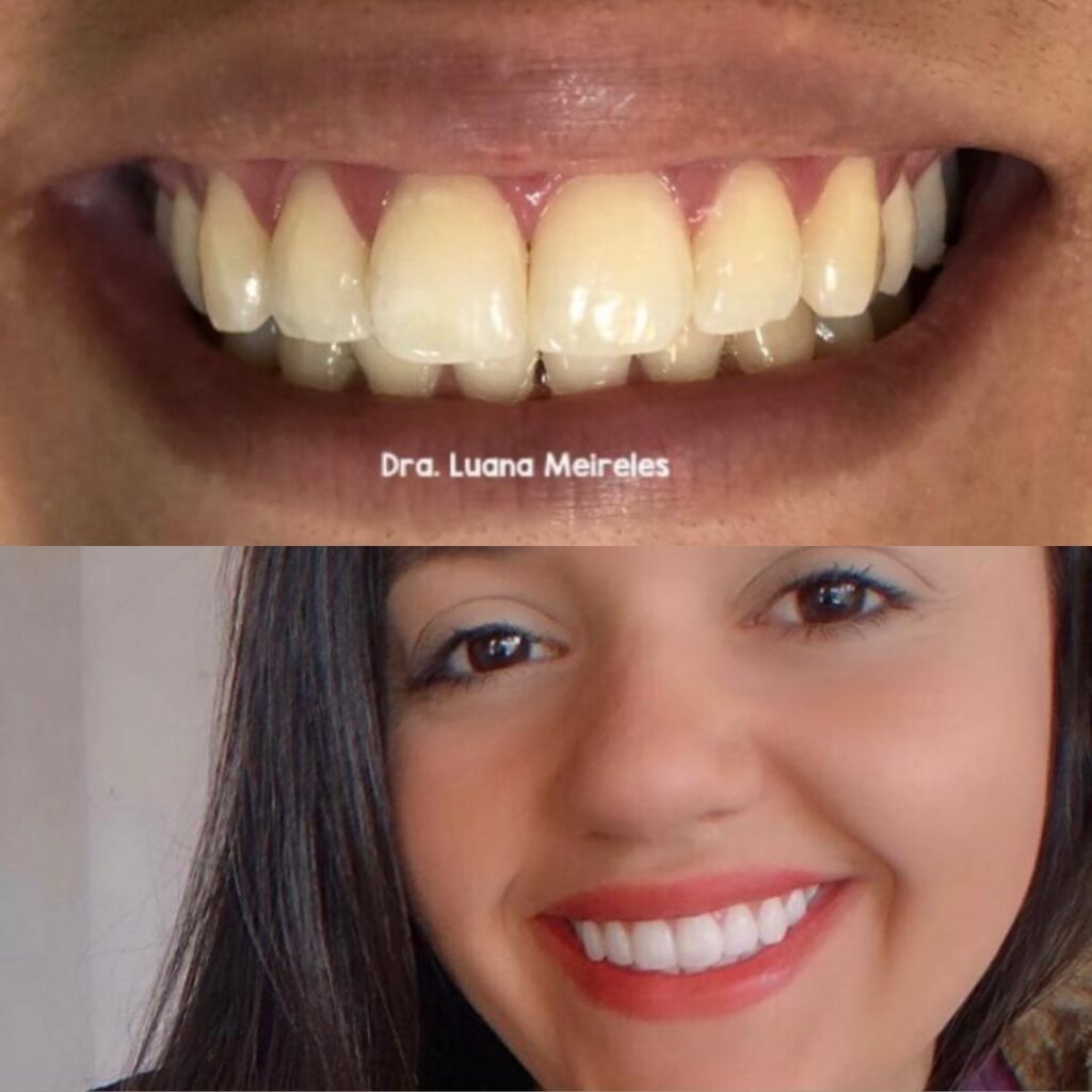 Clareamento Dental - Dra. Luana Meireles - Agende Sua Avaliação